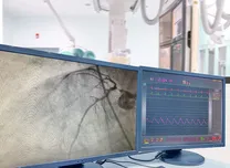 High Calcium Scores Provides Limited Diagnostic Value for Angiography