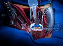 Early AF Ablation Reduces Recurrence in Heart Failure Patients