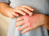 Adhesive Devices Linked to Allergic Contact Dermatitis in Youth With Type 1 Diabetes