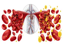 Age and Hypercholesterolemia Predict Long-Term Neuropathy Risk in T2DM