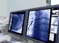 Superior Vena Cava Isolation Improves Atrial Fibrillation Ablation Outcomes