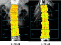 Arterial Stiffness Associated With Bone Microarchitectural Decline in T2DM