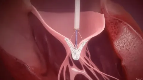 Heart Valve