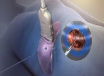 In Ischemic VT, Ablation Reduces ICD Interventions Compared With Anti-Arrhythmic Drugs