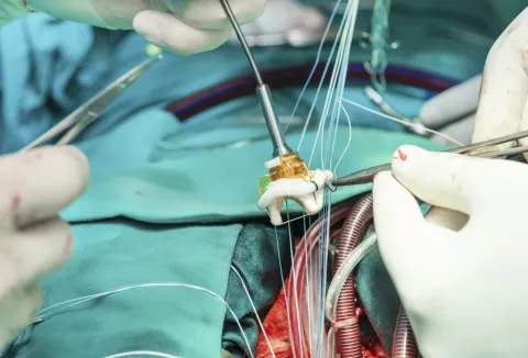 Catheter