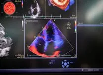 AHA 2025 Session: Ultrafast Contrast Echocardiography Reveals Greater Ischemia Burden