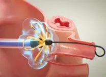 High-Voltage Pulsed Field Ablation Shows Early Efficacy in Scar-Related VT 