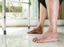 AHA 2025 Sessions: Deep Learning Quantifies Progressive Calf Muscle Density Loss in PAD