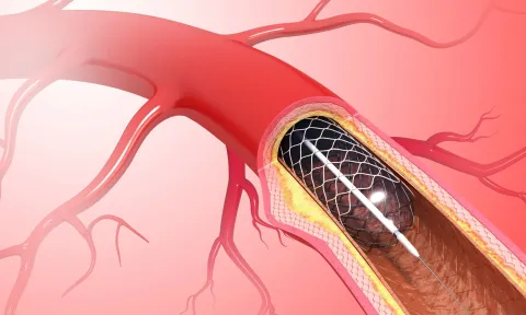 Percutaneous-Coronary-Intervention