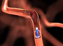 OA and BA Achieve Similar Stent Expansion in Severe Coronary Calcification