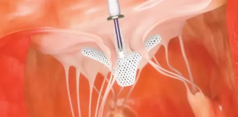 Heart Valve