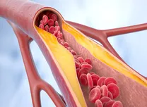 LDL-C Elevation Linked to Non-Calcified Plaque Despite Zero Calcium Score