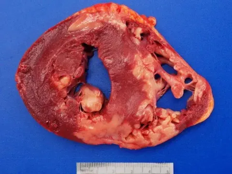 heart dissection