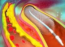 Nearly Half of Post-PCI Coronary Events Occur in Untreated Segments