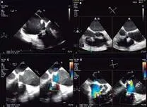 Corrected PISA Improves Accuracy of Tricuspid Regurgitation Quantification