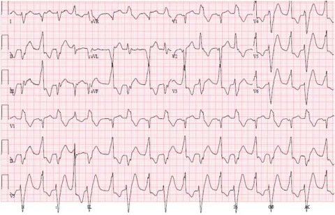 ECG of a patient with catecholaminergic polymorphic ventricular tachycardia