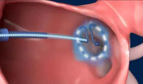 Pulsed field ablation system