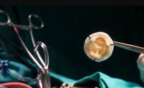 valve surgery