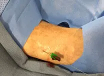 AHA 2025 Sessions: Pedal-Access Atherectomy Shows High Success With Low Complications in Calcified PAD 