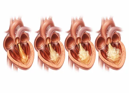 Tricuspid and Echo