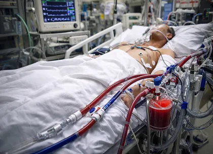 ECMO in Cardiogenic Shock