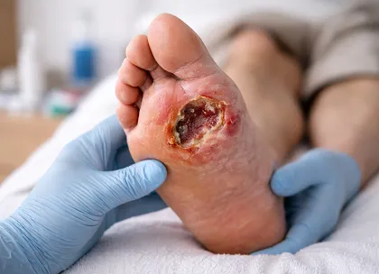 Diabetic Foot Disease