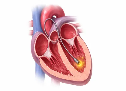 Right Ventricular Pacing