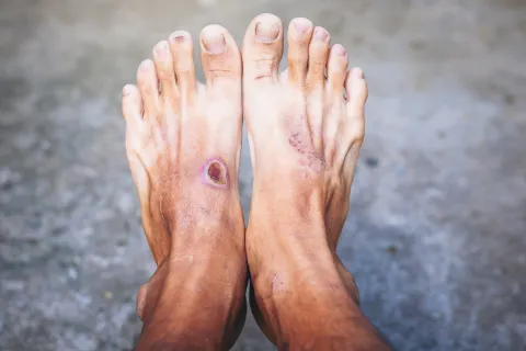 Six-Month Healing in DFI Unrelated to Severity or Antibiotics