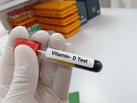 Low Vitamin D3 Levels Seen in Patients With DME