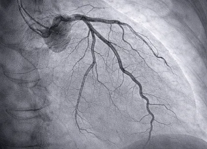 CT Angiography