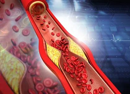 Atherosclerosis in CAD