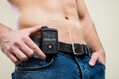 A real-world study of 305 youths with type 1 diabetes found early improvement in HbA1c after AID transition, with regression toward baseline by 24 months