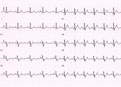ECG AF