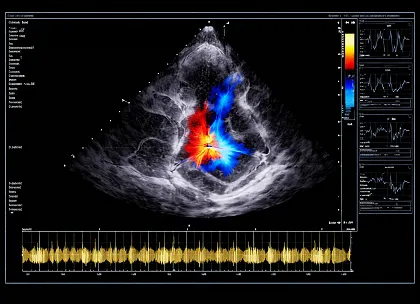 Mitral Stenosis