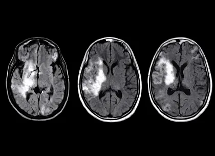 Stroke