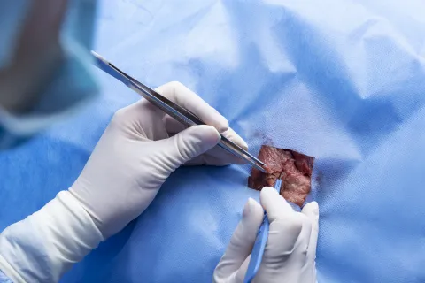 Kidney Biopsy Reveals Non-Diabetic Kidney Disease in Atypical T2DM Proteinuria