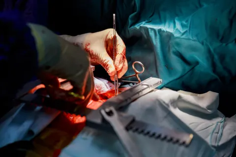 PTDM Raises Infection and Rejection Burden After Kidney Transplant
