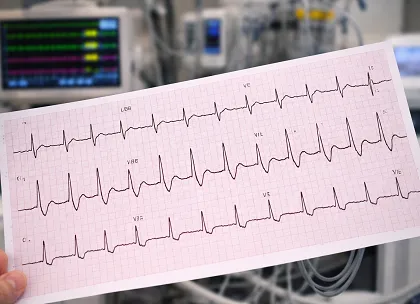 LBBB