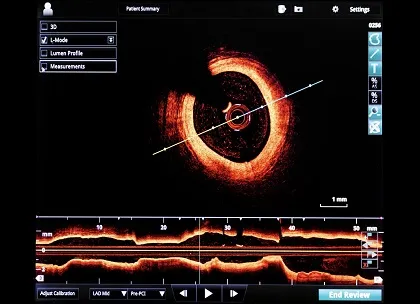 OCT in PCI