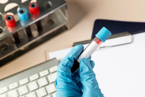 1-h Glucose Challenge Test Improves CFRD Screening in CF