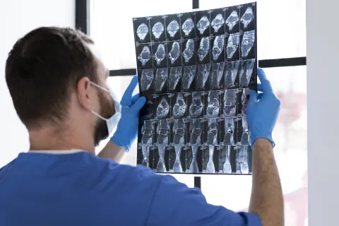 Recurrent Ischemic Stroke Lower With SGLT2i in T2DM 