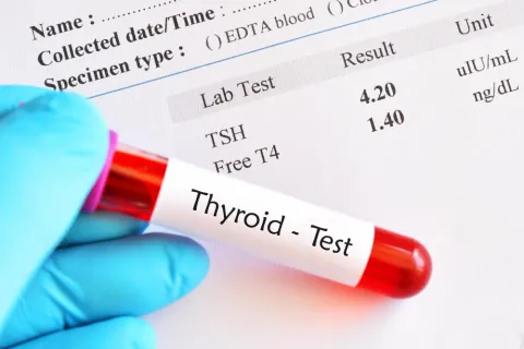 FT3 Levels Distinguish Early vs Advanced Nephropathy in T2DM