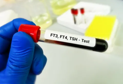 FT3/FT4 Ratio Identifies Type 2 Diabetes in NAFLD Patients