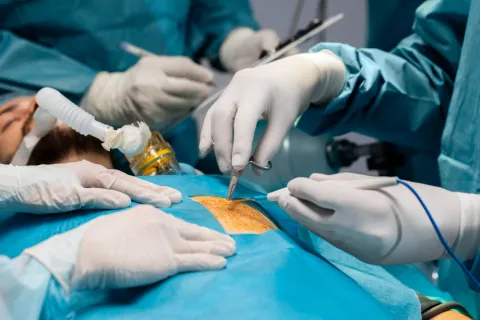 Bariatric Surgery vs Semaglutide Shows Mixed MASLD Outcomes in T2DM