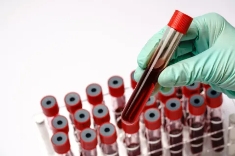 One-Hour OGTT Glucose Identified More Diabetes Cases