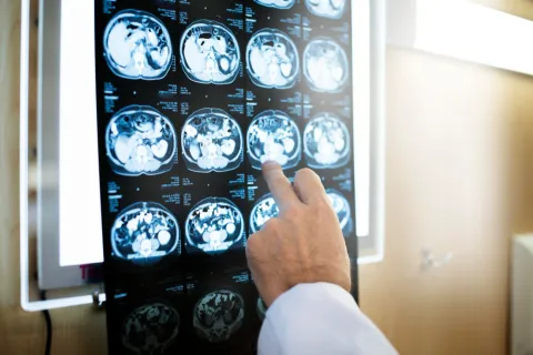 Brain MRI Reveals Early Structural Changes in Type 1 Diabetes