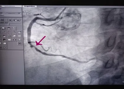 Angiography