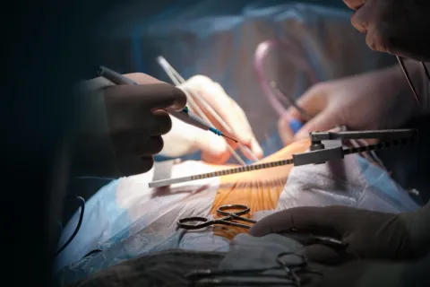 SGLT2 Inhibitors Reduced Rejection After Heart Transplant