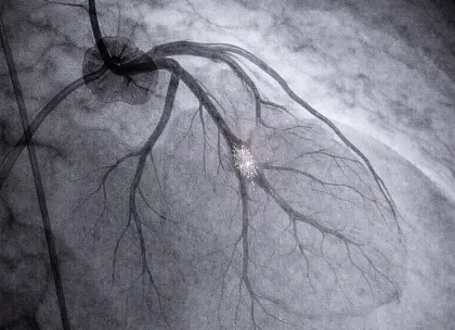Ischemia Risk