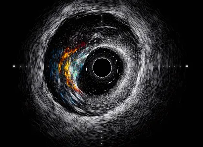 Intravascular Ultrasound